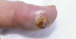 Dog bite 2025 finger treatment