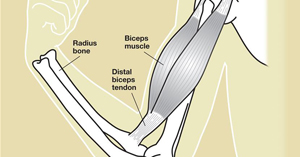 distal biceps tendonitis