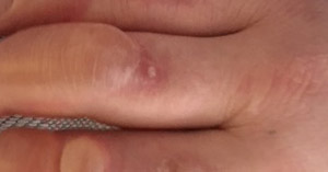 frostbite finger