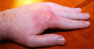 What Is Gout In Hands