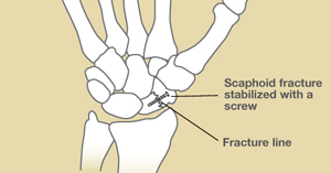 Scaphoid Fracture Symptoms Treatment The Hand Society