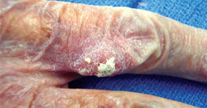 Skin Cancer of the Hand & Upper Extremity