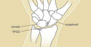 TFCC Tear: Causes and Symptoms | The Hand Society