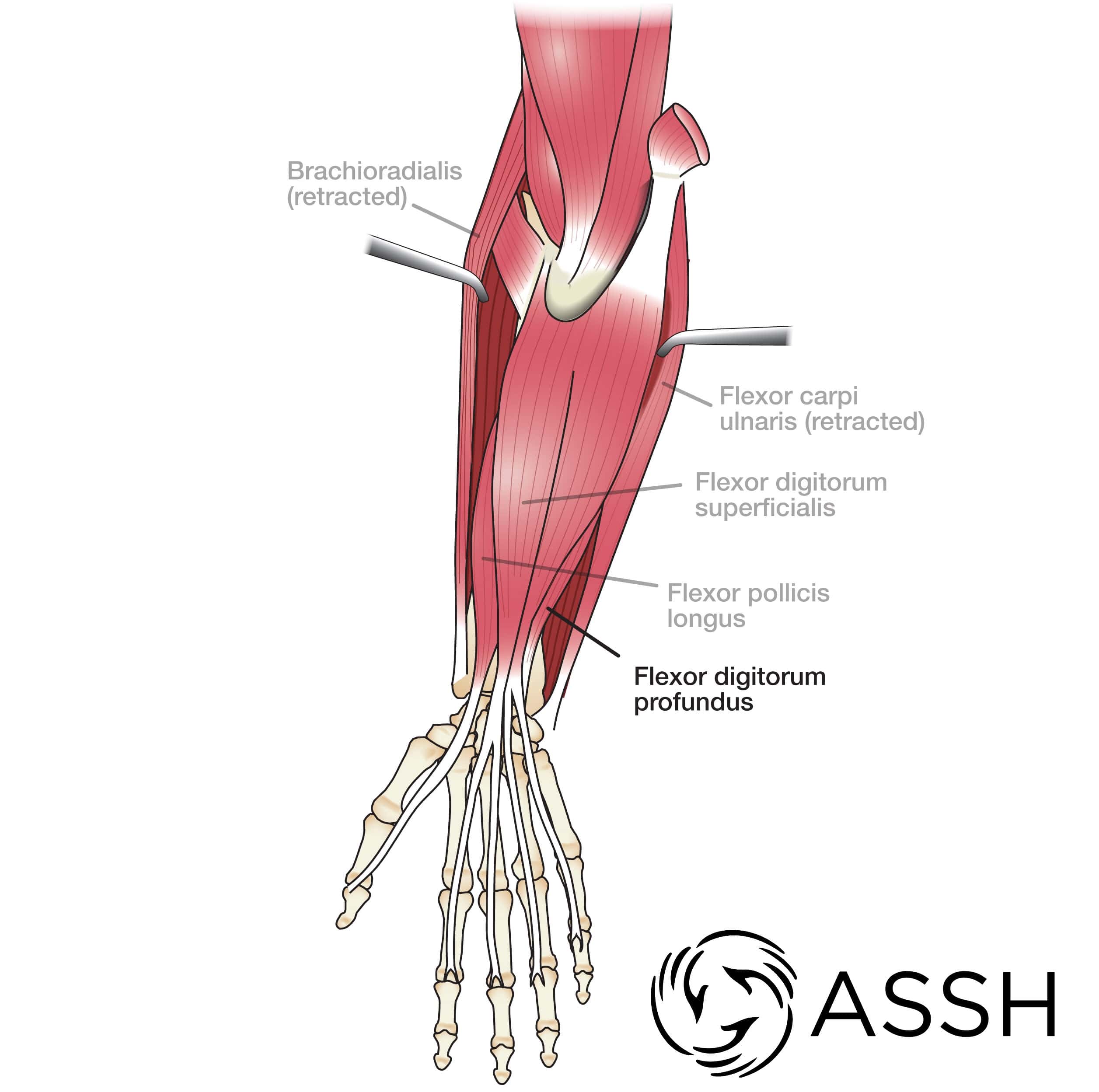 wrist flexor tendons