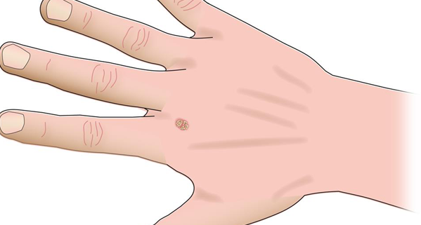 4-common-types-of-hand-tumors-the-hand-society