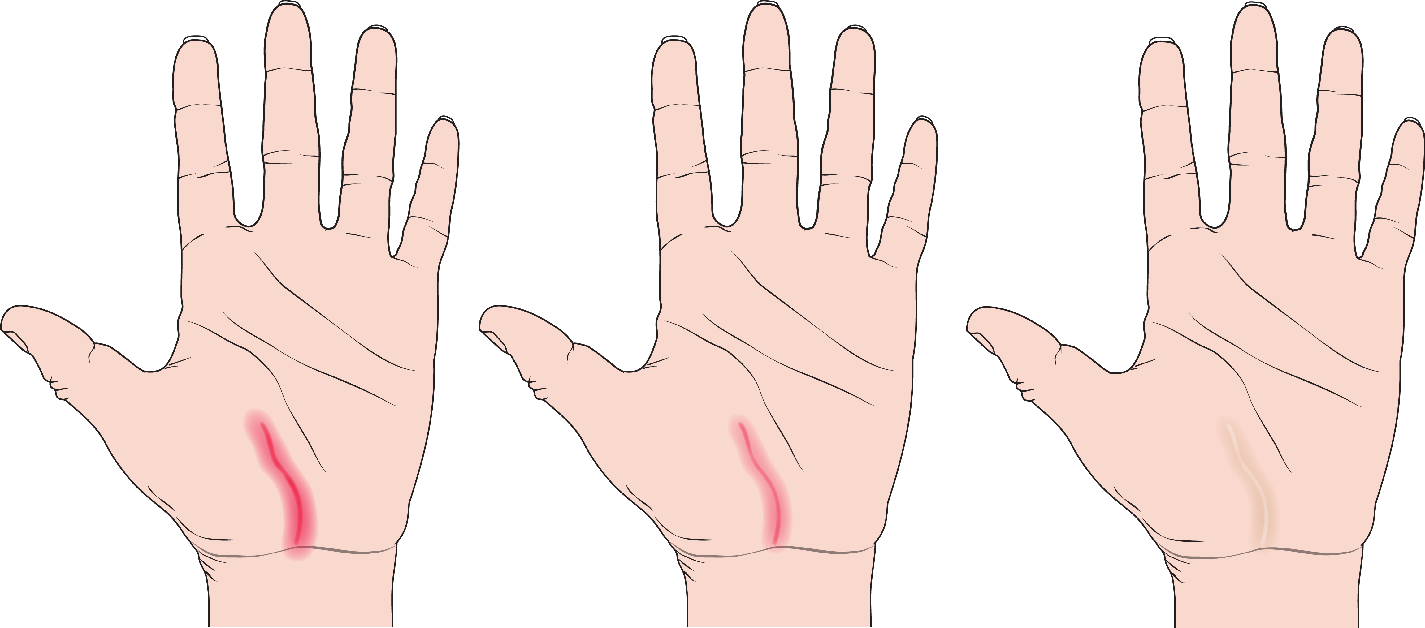 5 Ways to Heal a Scar The Hand Society