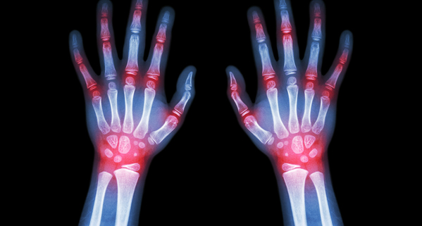 8 Examples of Systemic Diseases | The Hand Society