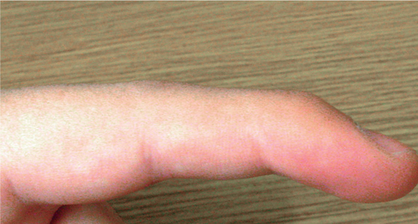 Mallet Finger: Causes, Symptoms, and Treatment