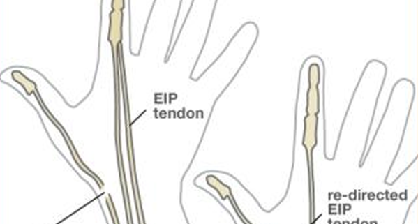 4 Reasons You May Need Tendon Transfer Surgery | The Hand Society