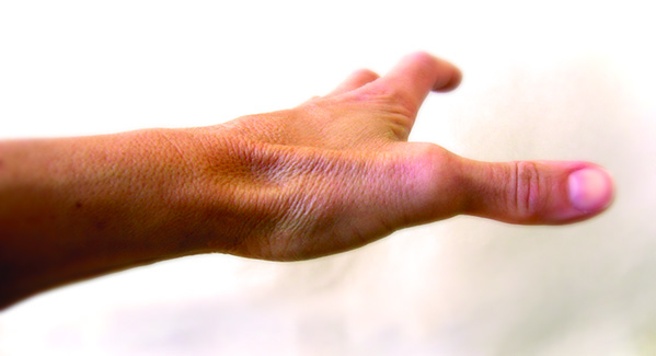 Cubital Tunnel Syndrome Treatment in Raleigh by Dr. Erickson