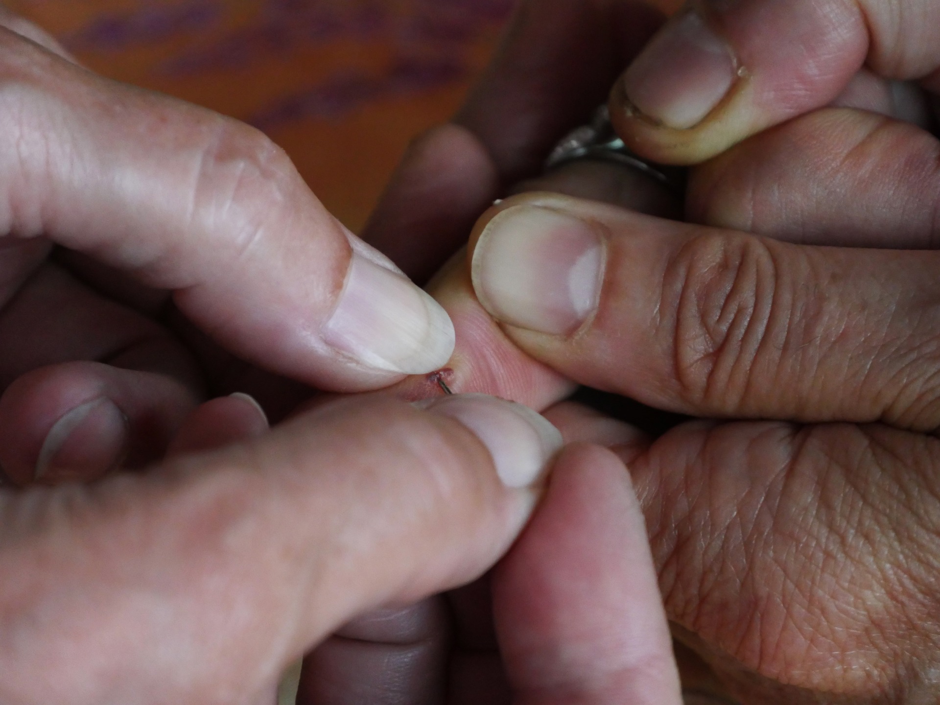 Splinters and Other Foreign Bodies in the Hand